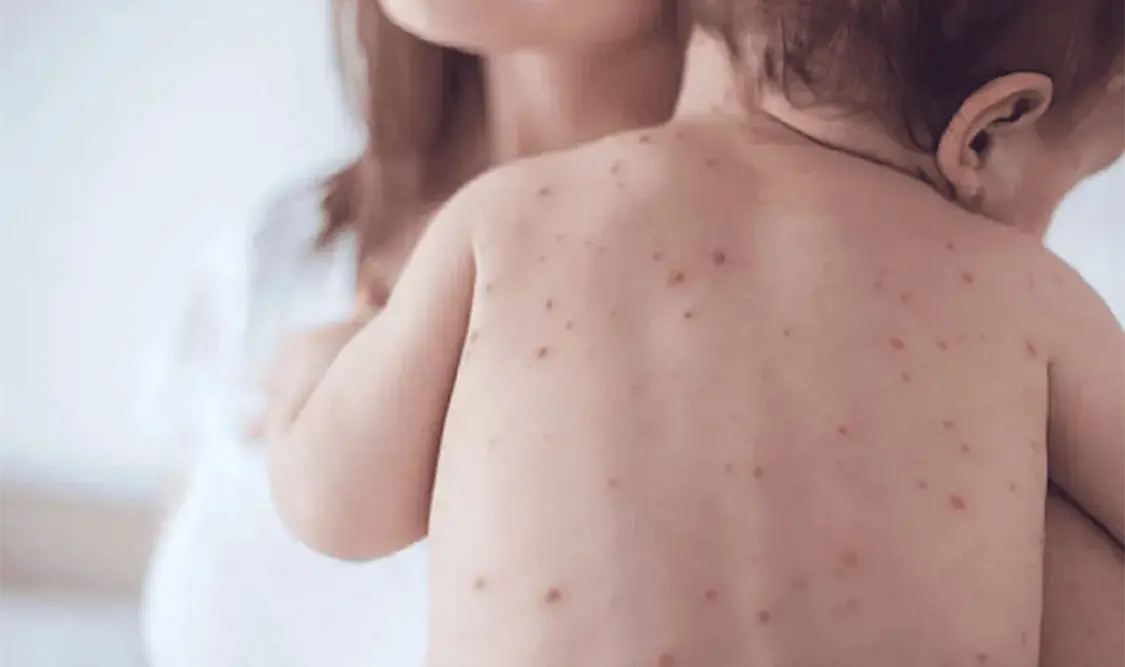 Cómo prevenir el sarampión