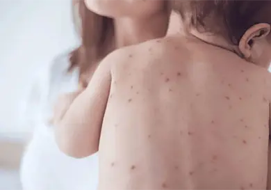 Cómo prevenir el sarampión