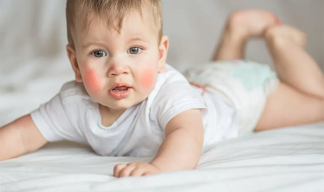 Dermatitis atópica en bebés