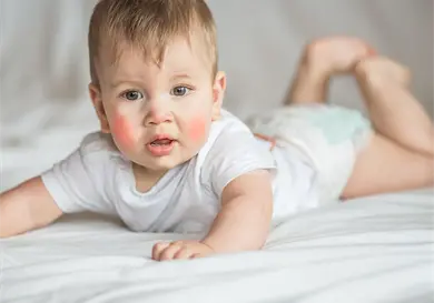 Dermatitis atópica en bebés