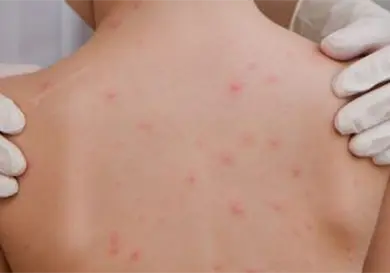 Se aceleran contagios de sarampión en Tabasco