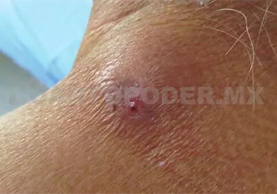 Chiapas, 1er lugar por casos de miasis