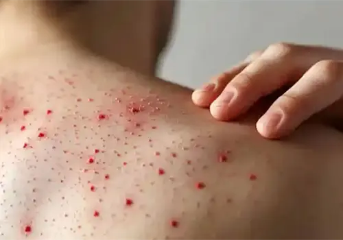 Suman 40 las muertes causadas por sarampión