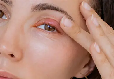 ¿Te salió una bolita en el ojo? ¿Te salió una bolita en el ojo?